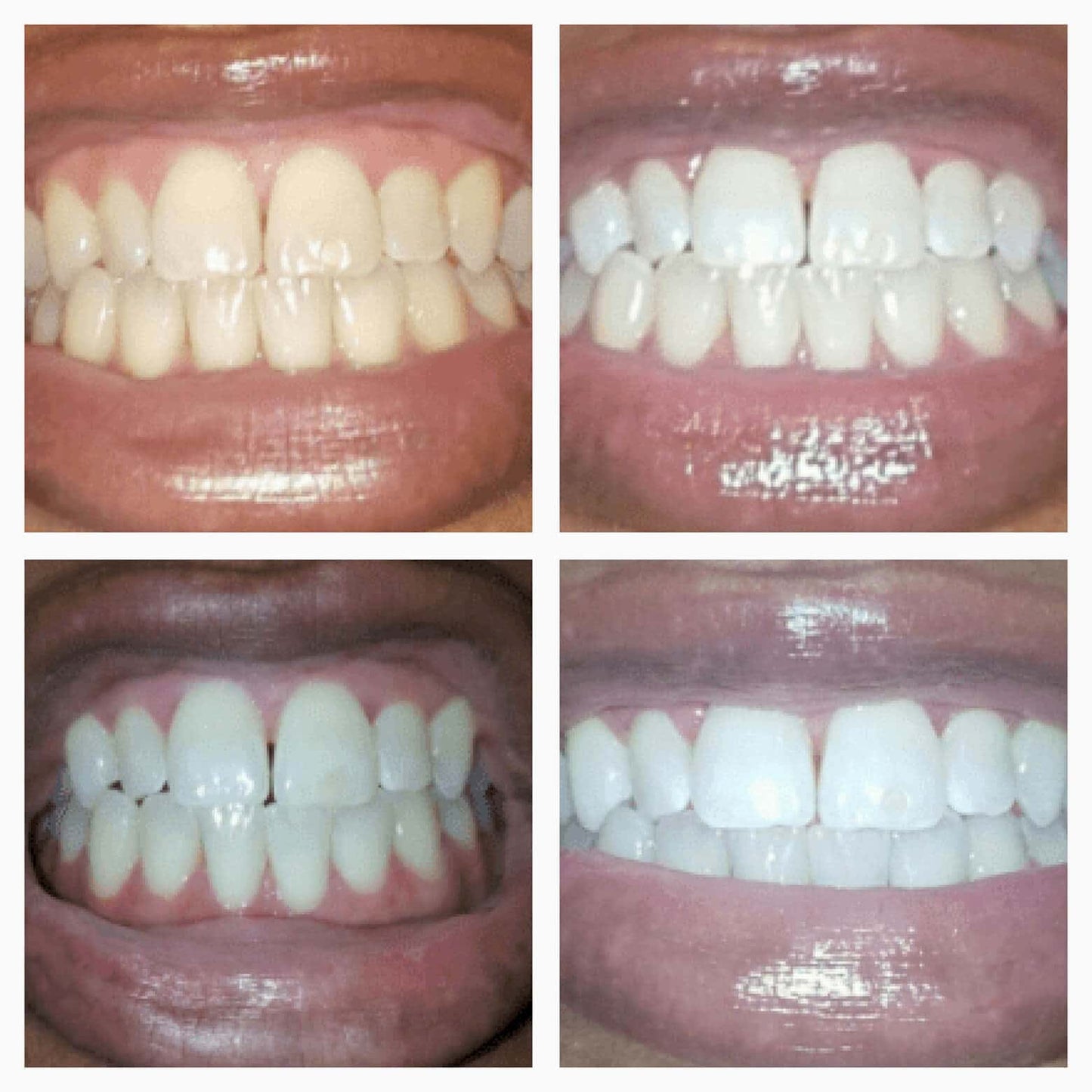 Teeth Whitening Gold Serum Pen – Dual-Peroxide with Xylitol