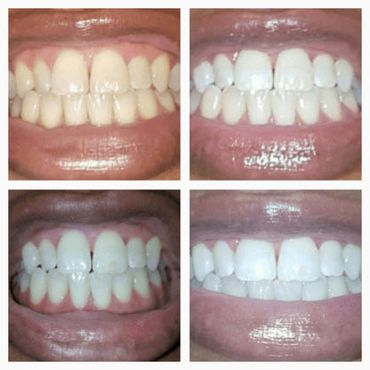Teeth Whitening Gold Serum Pen – Dual-Peroxide with Xylitol
